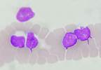 A 5-Feature Radiomics Model to Predict Refractory Disease in Early-Stage Hodgkin Lymphoma A 5-Feature Radiomics Model to Predict Refractory Disease in Early-Stage Hodgkin Lymphoma