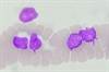 R-THP-COP a New Therapeutic Alternative for Diffuse Large B Cell Lymphoma R-THP-COP a New Therapeutic Alternative for Diffuse Large B Cell Lymphoma