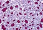 MEK1/2 Inhibitor After RAI Fails to Improve Outcomes in High-Risk Nonmetastatic Thyroid Cancer MEK1/2 Inhibitor After RAI Fails to Improve Outcomes in High-Risk Nonmetastatic Thyroid Cancer