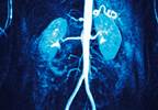 Nivolumab-Ipilimumab Survival Benefit in Advanced RCC Confirmed Nivolumab-Ipilimumab Survival Benefit in Advanced RCC Confirmed