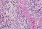 Gastric Linitis Plastica Diagnosis Uses Endoscopic and Radiologic Studies Approach Gastric Linitis Plastica Diagnosis Uses Endoscopic and Radiologic Studies Approach