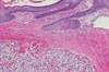 Advanced Renal Cell Carcinoma: Interviews With Neeraj Agarwal, MD, and Ulka Vaishampayan, MD Advanced Renal Cell Carcinoma: Interviews With Neeraj Agarwal, MD, and Ulka Vaishampayan, MD