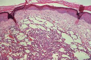 Although aldoxorubicin did not improve OS, the available evidence suggests that it is nevertheless superior to doxorubicin — particularly among patients with liposarcoma and leiomyosarcoma. Although aldoxorubicin did not improve OS, the available evidence suggests that it is nevertheless superior to doxorubicin — particularly among patients with liposarcoma and leiomyosarcoma.
