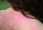 Dermatomyositis and Cancer Risk Dermatomyositis and Cancer Risk