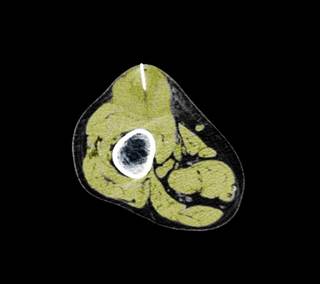 A study investigating the effects of adjuvant chemotherapy showed that treatment improved metastases-free survival and overall survival among patients with soft-tissue sarcoma and high-risk factors. A study investigating the effects of adjuvant chemotherapy showed that treatment improved metastases-free survival and overall survival among patients with soft-tissue sarcoma and high-risk factors.