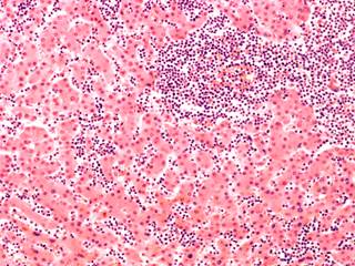 Researchers reveal the results of the phase 2 CLL2-BAG trial, which evaluated sequential bendamustine followed by obinutuzumab and venetoclax in patients with CLL. Researchers reveal the results of the phase 2 CLL2-BAG trial, which evaluated sequential bendamustine followed by obinutuzumab and venetoclax in patients with CLL.