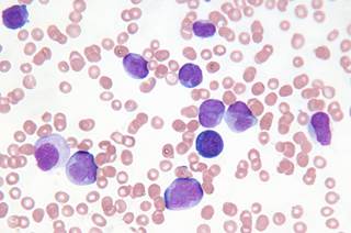 A prototype intervention increased adherence to tyrosine kinase inhibitor therapy in some patients with chronic myeloid leukemia. A prototype intervention increased adherence to tyrosine kinase inhibitor therapy in some patients with chronic myeloid leukemia.