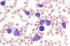 Second-Generation TKIs May Be Effective After First-Line Imatinib Failure in Pediatric CML Second-Generation TKIs May Be Effective After First-Line Imatinib Failure in Pediatric CML
