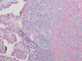 Telotristat represents a new treatment option that may decrease diarrhea incidence with a relatively safe side effect profile. Telotristat represents a new treatment option that may decrease diarrhea incidence with a relatively safe side effect profile.