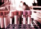 Diabetic ESRD Linked to Elevated Fibrinogen Diabetic ESRD Linked to Elevated Fibrinogen