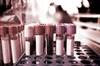 Diabetic ESRD Linked to Elevated Fibrinogen Diabetic ESRD Linked to Elevated Fibrinogen