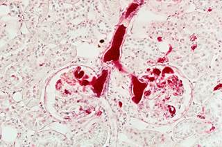 Insights into controversial results of trials evaluating adjuvant vascular endothelial growth factor tyrosine kinase inhibitors in high-risk renal cell carcinoma. Insights into controversial results of trials evaluating adjuvant vascular endothelial growth factor tyrosine kinase inhibitors in high-risk renal cell carcinoma.