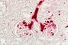 Dialysis and Transplant Patients at Increased Risk for Cancer Death Dialysis and Transplant Patients at Increased Risk for Cancer Death