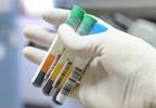 Kidney Cancer Progression Linked to Preop Cardiovascular Biomarkers Kidney Cancer Progression Linked to Preop Cardiovascular Biomarkers