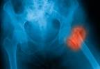 Stroke Risk Increased in Patients With Hip Fracture Stroke Risk Increased in Patients With Hip Fracture