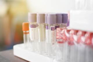 Extramedullary multiple myeloma is increasingly encountered in the clinic and most patients will need aggressive treatment. Extramedullary multiple myeloma is increasingly encountered in the clinic and most patients will need aggressive treatment.