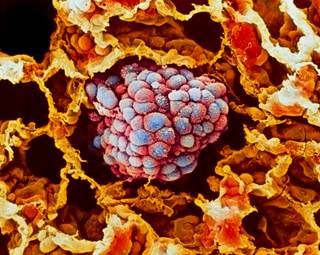 The only difference observed by researchers was an increased risk of squamous cell skin cancer in patients treated with abatacept. The only difference observed by researchers was an increased risk of squamous cell skin cancer in patients treated with abatacept.