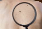 Selumetinib Plus Dacarbazine Does Not Improve Uveal Melanoma Outcomes Selumetinib Plus Dacarbazine Does Not Improve Uveal Melanoma Outcomes