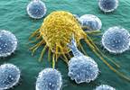 Cancer History Common in Newly Diagnosed Patients Cancer History Common in Newly Diagnosed Patients