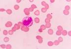 Spontaneous Regression of Cancer: Explanations and Predictions Spontaneous Regression of Cancer: Explanations and Predictions