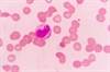 Spontaneous Regression of Cancer: Explanations and Predictions Spontaneous Regression of Cancer: Explanations and Predictions