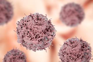 In a phase 3 trial, durvalumab was found to prolong survival in patients with stage III NSCLC. In a phase 3 trial, durvalumab was found to prolong survival in patients with stage III NSCLC.