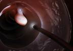 Colorectal Cancer Screening: Utility of Septin-9 Assays Colorectal Cancer Screening: Utility of Septin-9 Assays