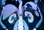 Two-Drug Combination Superior to Sunitinib in Patients With Untreated Advanced Renal Cell Carcinoma Two-Drug Combination Superior to Sunitinib in Patients With Untreated Advanced Renal Cell Carcinoma