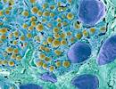 Biomarkers of Pancreatic Function in CF Improved With Lumacaftor/Ivacaftor Biomarkers of Pancreatic Function in CF Improved With Lumacaftor/Ivacaftor