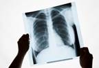 In the Clinic: Managing Malignant Pleural Effusions In the Clinic: Managing Malignant Pleural Effusions
