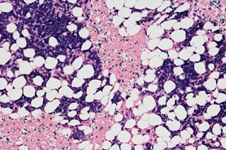 Studying how MGUS and myeloma clones change over time might yield new insights into myeloma’s molecular heterogeneity. Studying how MGUS and myeloma clones change over time might yield new insights into myeloma’s molecular heterogeneity.