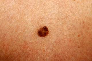 Two cases raise the question of whether abnormal activation of the hedgehog signaling pathway can lead to a protective effect on melanomas. Two cases raise the question of whether abnormal activation of the hedgehog signaling pathway can lead to a protective effect on melanomas.