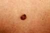Can Vismodegib Induce Melanoma in Patients Treated for Basal Cell Carcinoma? Can Vismodegib Induce Melanoma in Patients Treated for Basal Cell Carcinoma?