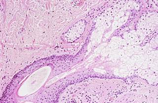 The management of toxicities and re-initiation of these medications should be made on a case by case basis. The management of toxicities and re-initiation of these medications should be made on a case by case basis.