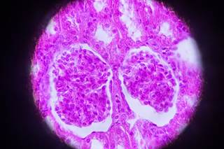 Kidney cancer and some other cancers tied to obesity are increasing the most rapidly among individuals younger than 50. Kidney cancer and some other cancers tied to obesity are increasing the most rapidly among individuals younger than 50.