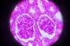 Combo Superior to Sunitinib in Advanced Renal Cell Carcinoma Combo Superior to Sunitinib in Advanced Renal Cell Carcinoma