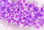 Bosutinib May Be Effective As First-Line Therapy in Chronic-Phase Chronic Myeloid Leukemia Bosutinib May Be Effective As First-Line Therapy in Chronic-Phase Chronic Myeloid Leukemia