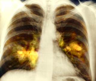 Efforts are underway to develop predictive molecular biomarkers that can improve patient selection for ICIs. Efforts are underway to develop predictive molecular biomarkers that can improve patient selection for ICIs.