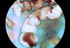 Obstructing Colorectal Cancer: Presentation and Stenting — In the Clinic Obstructing Colorectal Cancer: Presentation and Stenting — In the Clinic