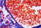 In Focus: Voxtalisib for CLL and B-Cell Lymphomas In Focus: Voxtalisib for CLL and B-Cell Lymphomas