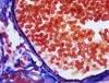Higher-Dose Immunoglobulin Replacement Therapy in Chronic Lymphocytic Leukemia Higher-Dose Immunoglobulin Replacement Therapy in Chronic Lymphocytic Leukemia