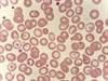 Identifying Treatment Failure in Patients With Chronic Myeloid Leukemia Identifying Treatment Failure in Patients With Chronic Myeloid Leukemia