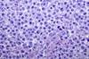 Brentuximab in Classical Hodgkin Lymphoma — In the Clinic Brentuximab in Classical Hodgkin Lymphoma — In the Clinic
