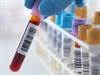 HIV-Associated Cancers: A Paradigm Shift? HIV-Associated Cancers: A Paradigm Shift?