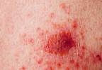 The Benefits of Adjuvant Immunotherapy in Melanoma The Benefits of Adjuvant Immunotherapy in Melanoma