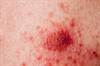 The Benefits of Adjuvant Immunotherapy in Melanoma The Benefits of Adjuvant Immunotherapy in Melanoma