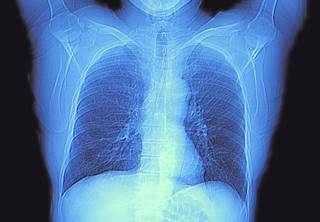 PD-1/PD-L1 ICI can offer remarkable benefits as first- and second-line treatments for NSCLC, but 80% of patients do not respond to immunotherapy, and many of those who do respond eventually see their PD-1/PD-L1 ICI can offer remarkable benefits as first- and second-line treatments for NSCLC, but 80% of patients do not respond to immunotherapy, and many of those who do respond eventually see their
