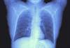 Immunotherapy for Lung Cancer: Are Combination Regimens a Path Forward? Immunotherapy for Lung Cancer: Are Combination Regimens a Path Forward?
