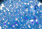 Long-Term Outcomes of Axicabtagene Ciloleucel: ZUMA-1 Long-Term Outcomes of Axicabtagene Ciloleucel: ZUMA-1