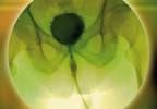 Adding Gemcitabine at the Time of Resection Reduces Recurrence, Cost in Early-Stage Bladder Cancer Adding Gemcitabine at the Time of Resection Reduces Recurrence, Cost in Early-Stage Bladder Cancer